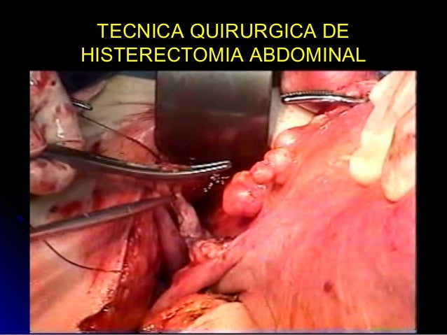 tecnica quirurgica de histerectomia